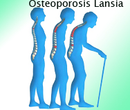 osteoporosis lansia